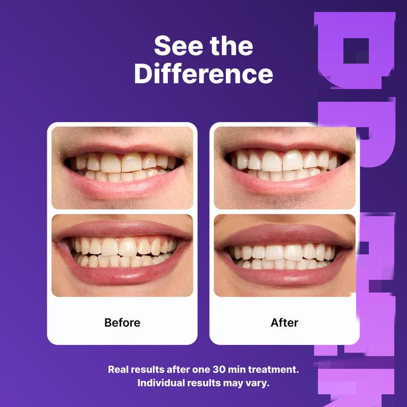 ✨ Purple Whitening Strips ✨ – Brighter Smile in 30 Minutes